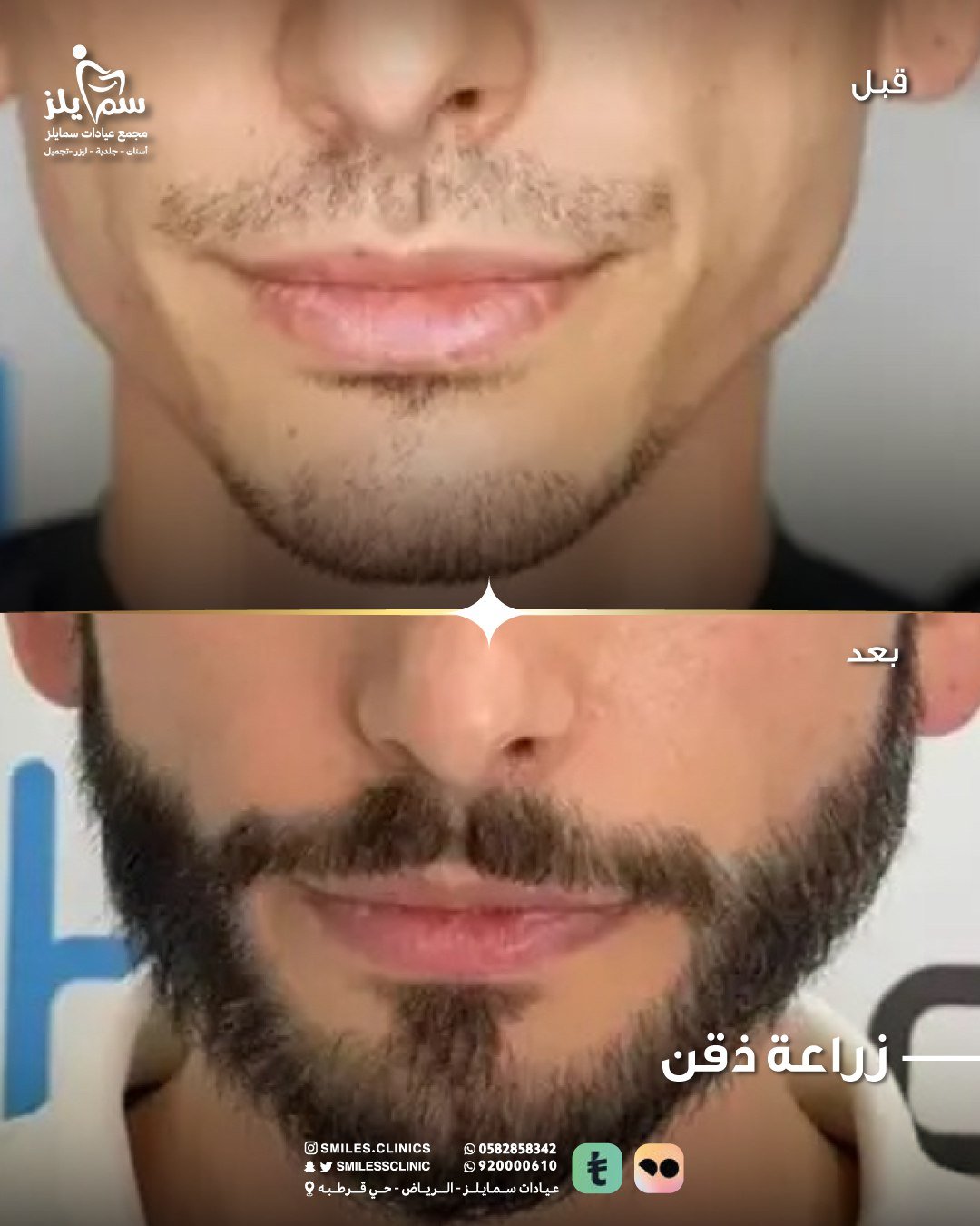 زراعة الشعر في الرياض