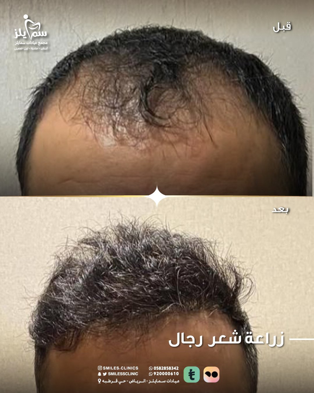 زراعة الشعر في الرياض
