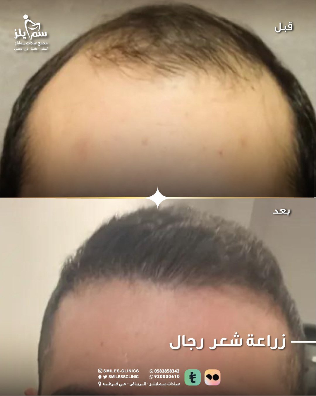 زراعة الشعر في الرياض